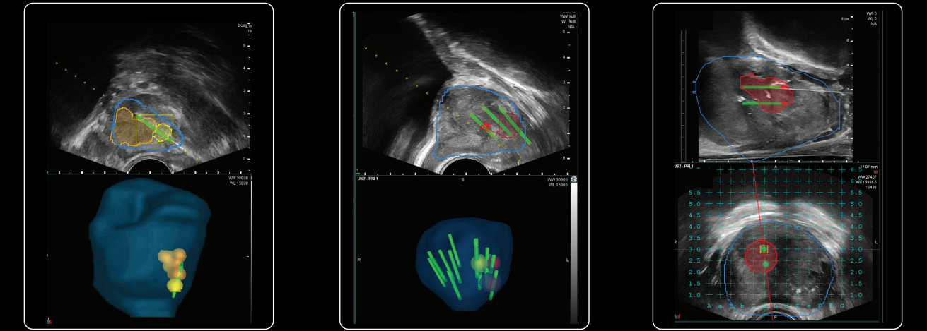 Técnica da fusão bkFusion free-hand com uso do ultrassomde biópsia de próstata transperineal