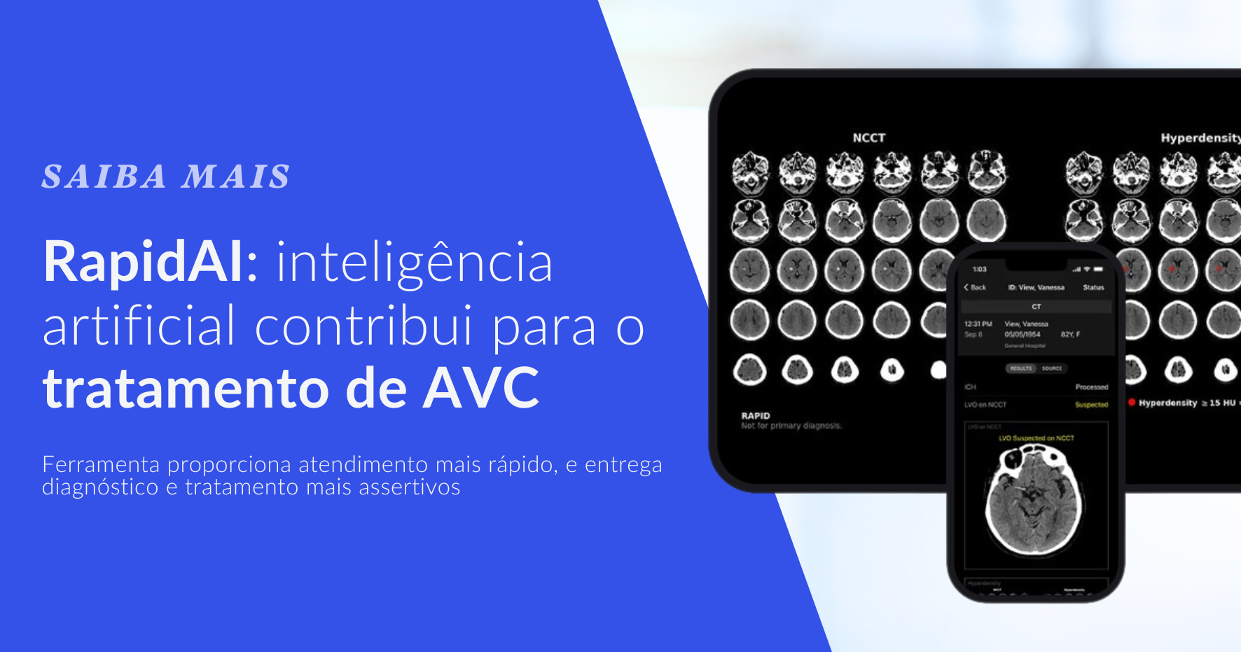 RapidAI: inteligência artificial contribui para o tratamento de AVC